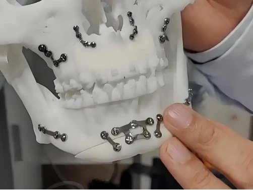 Titanium implants Titanium implants